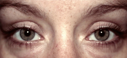 before lower eyelid surgery female patient in mid 20s