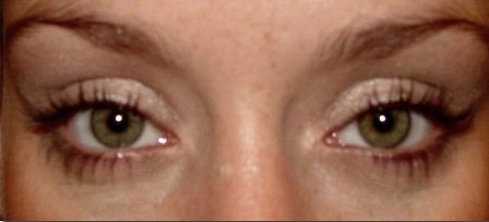 after lower eyelid surgery female patient in mid 20s