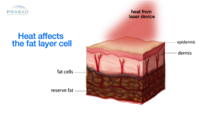 Heating device affects the fat layer cells illustration - a laser treatment for wrinkles treatment illustration