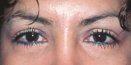 after female lower eyelid surgery