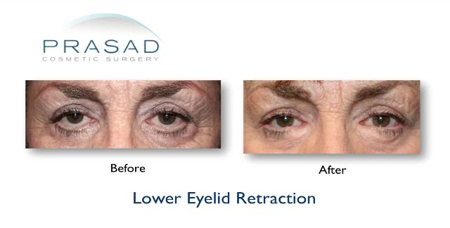 Lower Eyelid Retraction