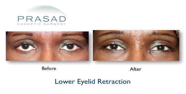 before and after lower eyelid retraction surgery on female patient with ethnic skin