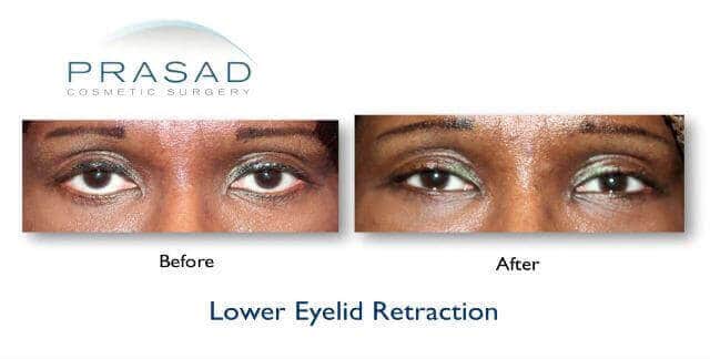 Under Eye Filler Before and After Photos - Prasad Cosmetic Surgery NY