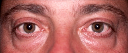 before lower eyelid surgery male patient in 30s