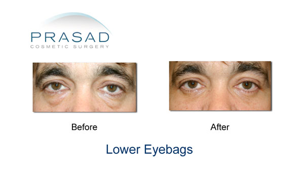male blepharoplasty before and after