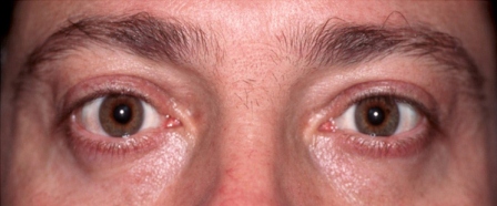 after lower eyelid surgery male patient in 30s