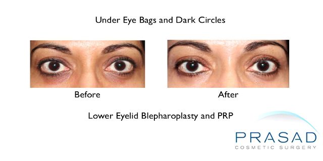 before and after under eye bags and dark circles treatment on female patient