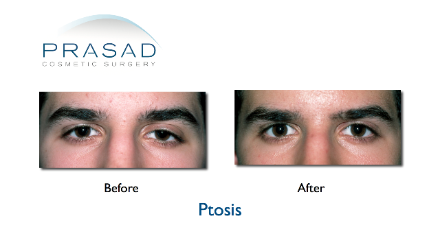 Ptosis before and afters