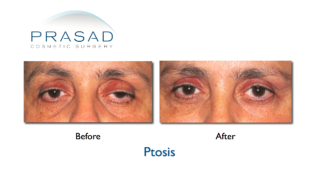 Ptosis Correction Surgery Eyelifts By Dr Amiya Prasad Md Facs