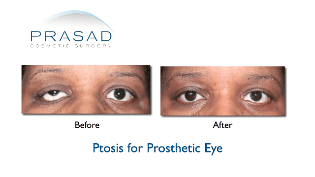 Patient with ptosis before and after surgery