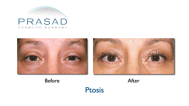 before and after ptosis surgery female patient