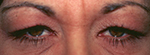 before Eyelid Blepharoplasty
