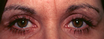 After Eyelid Blepharoplasty