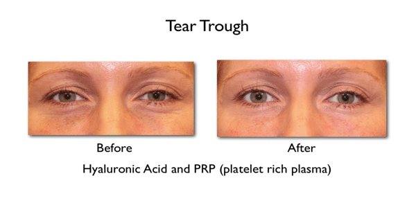 tear trough filler - before and after cosmetic filler and PRP treatment