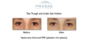Hollow Eyes Treatments - Fillers, PRP, and Tear Trough Implants