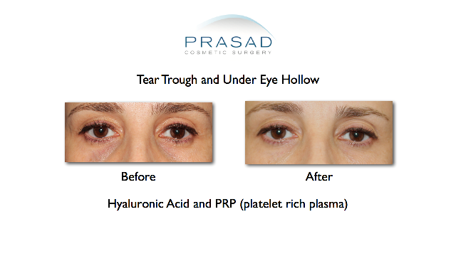 Before and After cosmetic filler and PRP treatment for Tear Trough 