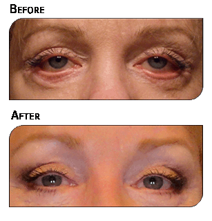 Corrective Eye lift revision Surgery on female patient Before and After results