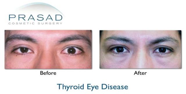 Thyroid Eye Disease before and after surgery male patient