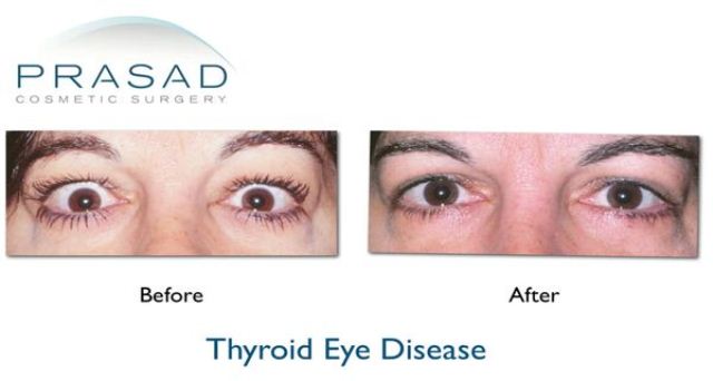 Thyroid Eye Disease before and after surgery female patient in early 40s