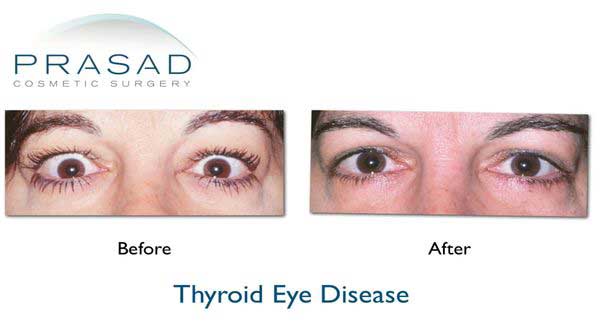 Thyroid Eye Disease Before And After 4 600w Eyelifts By Dr Amiya