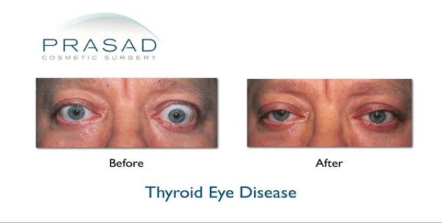 Thyroid Eye Disease before and after