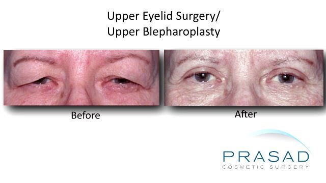 Upper Eyelid Surgery/Upper Blepharoplasty | Eyelifts by Dr. Amiya Prasad