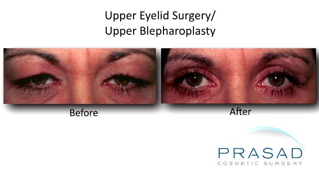 Upper Eyelid Surgery before and after
