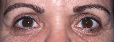 eye lift portfolio: after upper eyelid surgery female in 50s