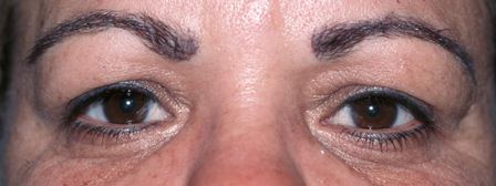 eye lift portfolio: before upper eyelid surgery female in 50s
