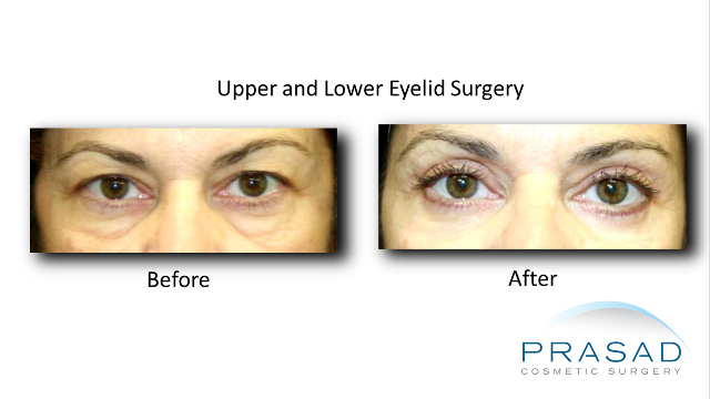before and after Upper and lower eyelid surgery of female Latina patient