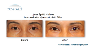 Hollow Eyes Treatments - Fillers, PRP, and Tear Trough Implants