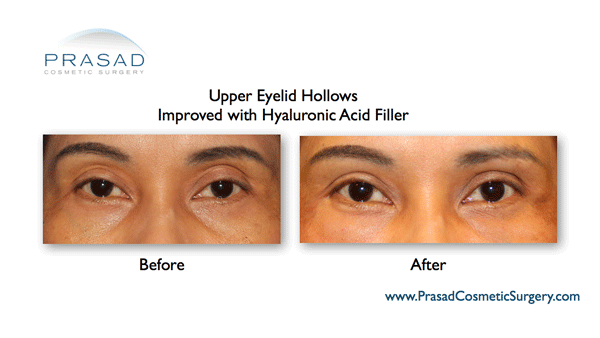 Upper eyelid hollowness treatment before and after by New York's eyelid specialist Dr. Prasad.