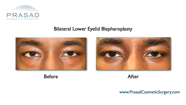 lower eyelid bleph transconjunctival dark skin