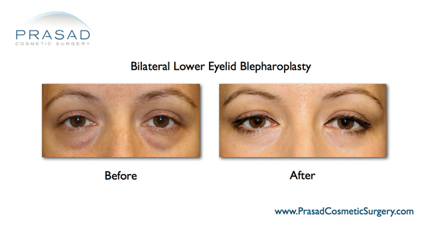 bilateral transconjunctival lower eyelid bleph