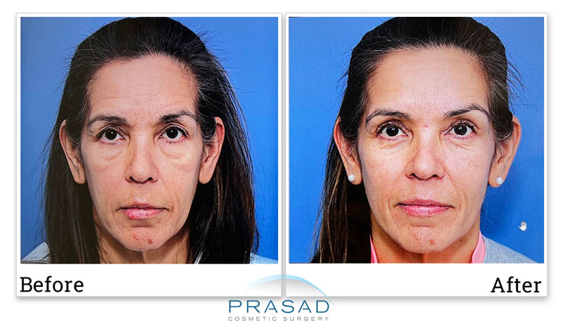 before and after eyelid surgery photo of female patient in her 50s of Dr. Prasad