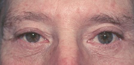 after lower eyelid blepharoplasty old male patient