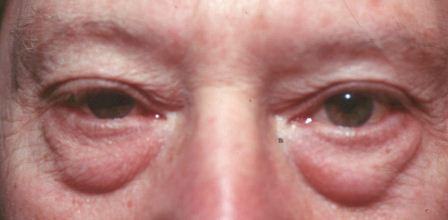 before lower eyelid surgery male patient