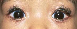 eyelid problem in children - ptosis in baby after surgery