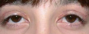 eyelid problems in children - child ptosis after surgery