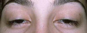 female child with congenital ptosis before surgery