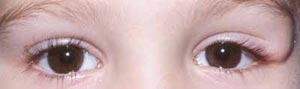 eyelid tumor problem in children