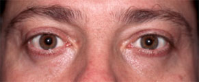 PUFFY LOWER EYELIDS – MAN after