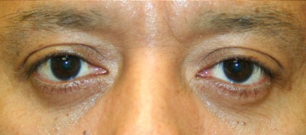after lower eyelid surgery on dark skin male patient