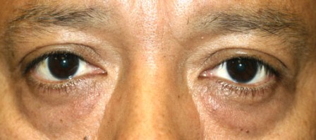 before lower eyelid surgery on dark skin male patient