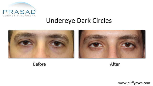 Male patient with dark circles under eyes and eye bags. Eye bags surgically removed while dark circles treated with PRP