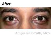 result after eye plastic surgery