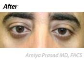 after male ethnic eye plastic surgery 