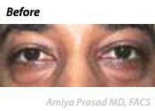 male patient with under eye bags before eye plastic surgery