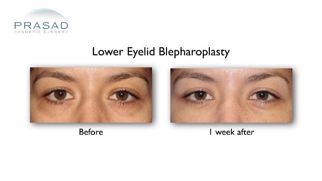 transconjunctival blepharoplasty before and 1 week after recovery. Surgery performed by NYC Doctor Amiya Prasad