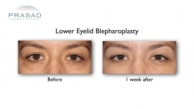 before and 1 week after lower eyelid blepharoplasty surgery recovery